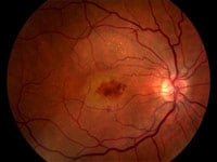 Age-Related Macular Degeneration