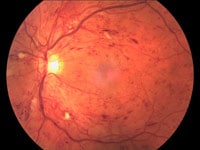 Diabetic Retinopathy